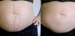 tri-ran-da-sau-sinh-bang-phuong-phap-tu-nhien